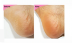 Esfolio foot & Heel Peeling mask